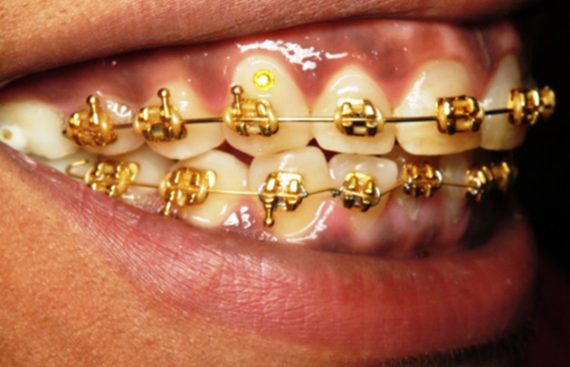 L’apparecchio per i denti in oro e diamanti
